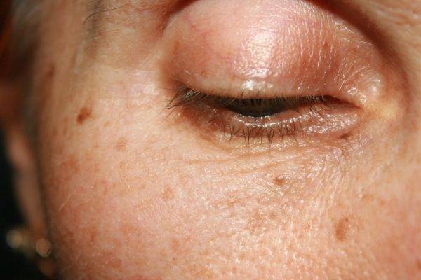 What Are Age Spots And How Can They Be Treated Your Skin Doctors