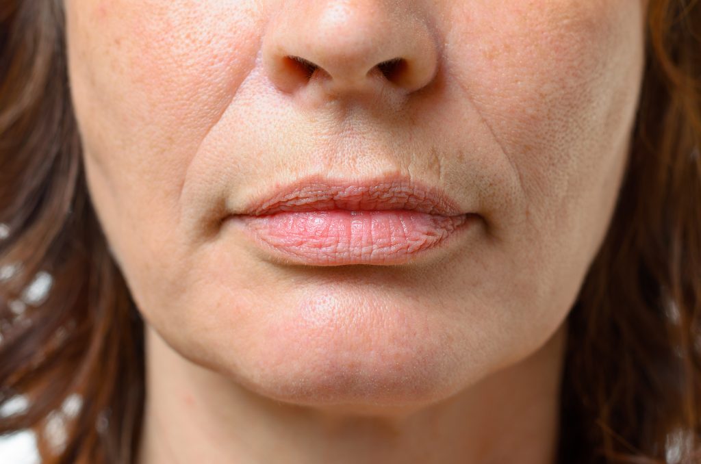 What is Jowls and how can it be treated? Your Skin Doctors